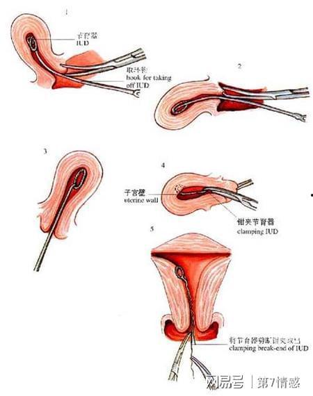 女人带环视频,真实视频解析
